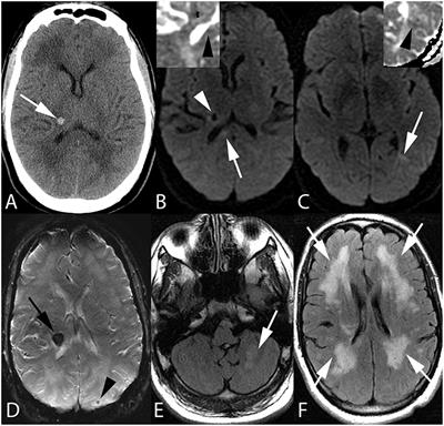 Imaging of Atypical and Complicated Posterior Reversible Encephalopathy Syndrome